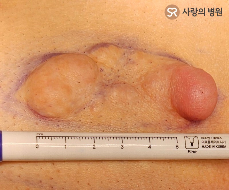 [엉덩이 지방종, 등 부위 피지낭종 수술 사례] 재발이 적도록 치료하는것이 관건입니다. [관....