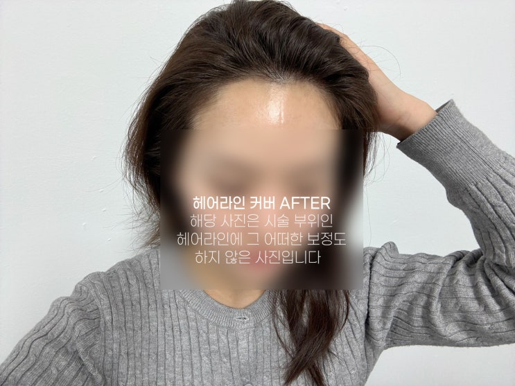  잠실헤어라인 교정 '스튜디오비비엘' 두피커버 후기 (결과, 통증)