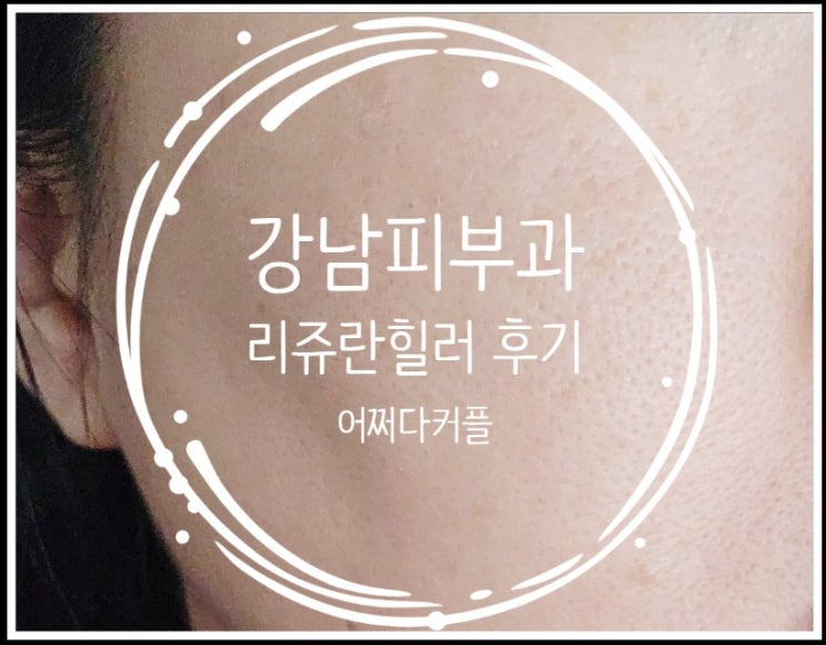  강남피부과 리쥬란힐러2cc 시술받고 온 솔직 후기