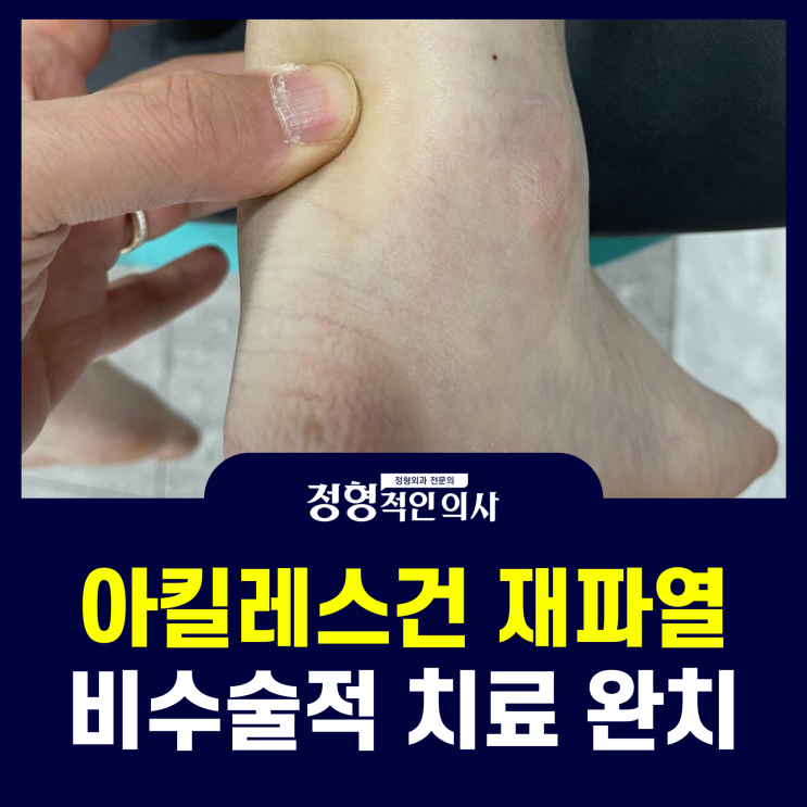  수술 후 8주째 아킬레스건 재파열, 비수술적 치료 과정 (의사 작성)