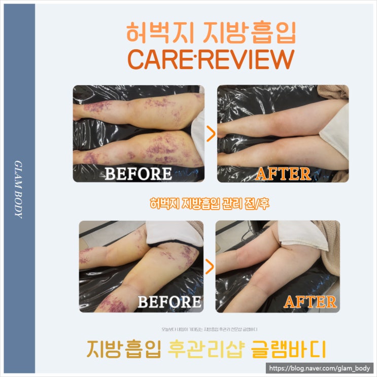  허벅지 지방흡입 바본.붓기.멍 관리 사례