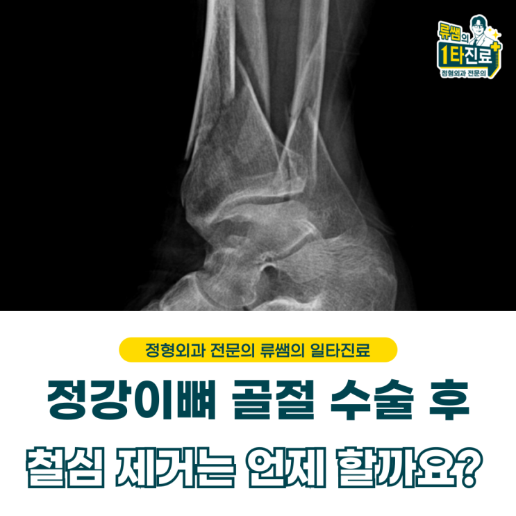  정강이 골절 수술 과정 및 재활 이후 핀 제거 시기  (의사작성)