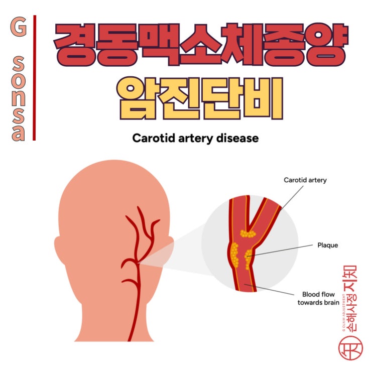  경동맥소체종양(D44.6), 일반암으로 보상받는 방법! - [암, 1부]