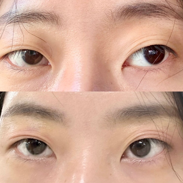  눈꺼풀 처짐 고민, 민트 실리프팅 효과 후기 (유지기간, 통증)