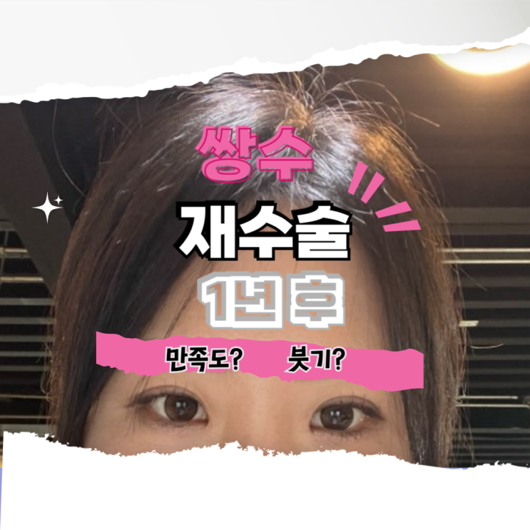  쌍수 재수술 1년 후, 만족도는?  솔직 후기!