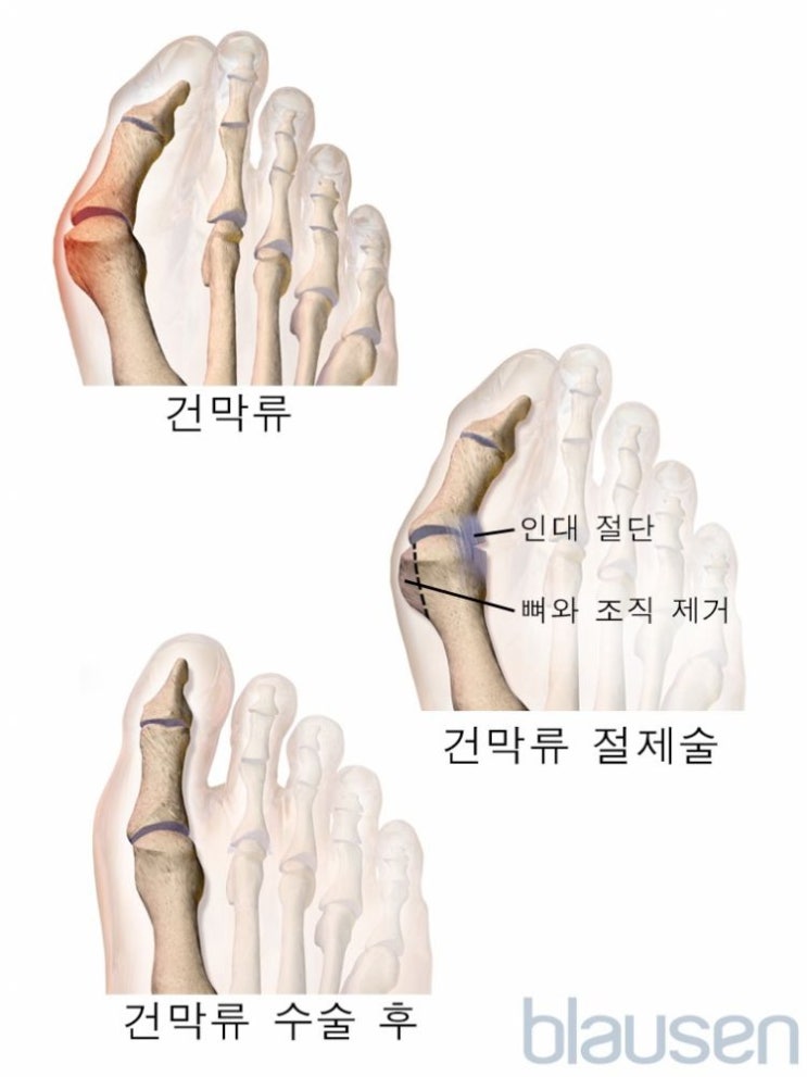 건막류