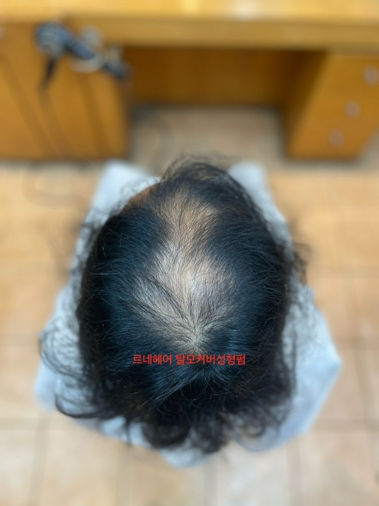  김해에서왔다구요? 저 이렇게심한 탈모도 가능하겠습니까? 원장님 도와주세요!/ 부산사상감전덕포명지하단대저남포주례개금전포명륜동래온천사직대연해운대광안수영망미용호남천