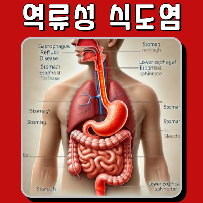 역류성 식도염, 방치하면 어떤 일이 벌어질까?