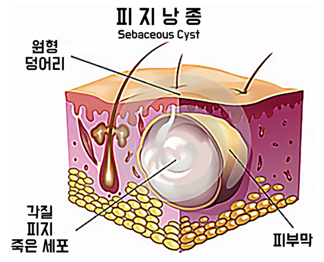외음부 종기 : 모낭염, 피지낭종, 곤지름, 바르톨린 낭종, 헤르페스, 유두종증에 대해 차이점 ....