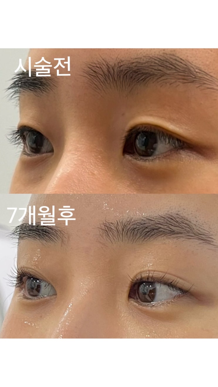  수술 없이 완벽한 눈매! 아미뷰티 플라즈마 쌍꺼풀 시술