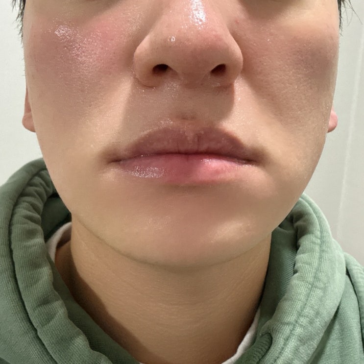 논현역 피부과 기미,색소 홍조 레이저 내돈내산 후기 효과