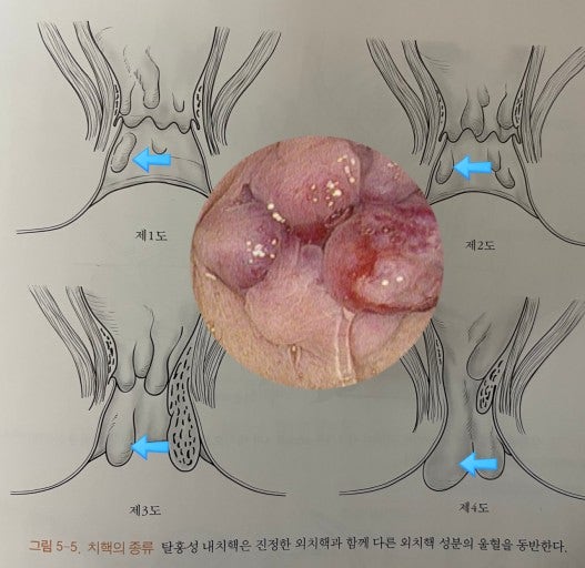 항문 살 튀어나옴 결국 치질수술했어요 [울산 항문외과]
