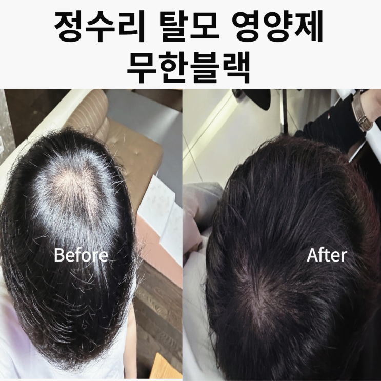  남자정수리탈모 초기 무한블랙 머리탈모영양제 사용후기