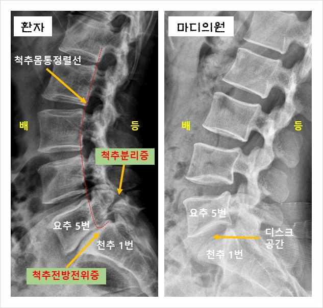  척추전방전위증 증상, 치료를 받아도 나아지지 않아요