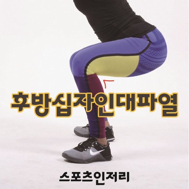 후방십자인대파열 어떻게 치료하게 될까요?
