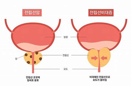  전립선 건강에 좋은 음식 VS 나쁜 음식