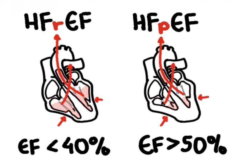 EF 의학용어 Ejection Fraction 과 심부전 HFrEF, HFpEF, EDV 공부하기 : 네이버 블로그