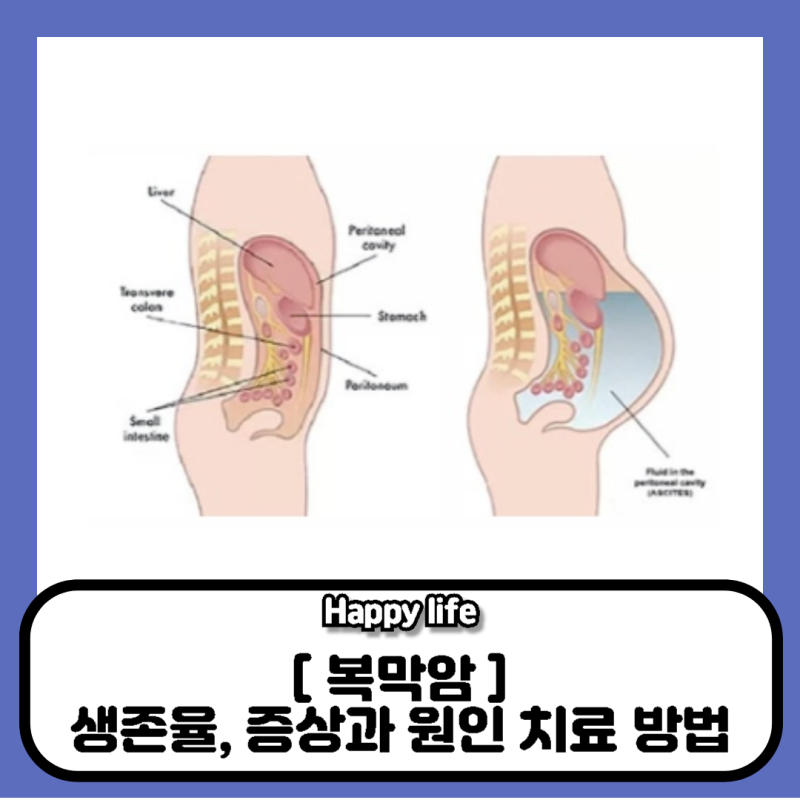 복막암 생존율, 증상과 원인 치료 방법