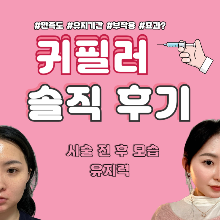  요정 귀 필러, 시술 전후 모습과 유지력 솔직 후기