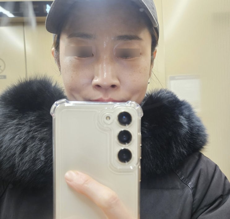 우만동피부과 40대 눈밑꺼짐 다크서클 셀아이 리얼후기 우만동피부과 40대 눈밑꺼짐 다크서클 셀아이 리얼후기