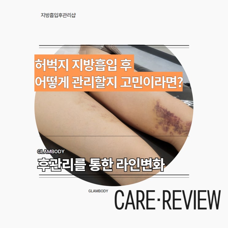  허벅지 지방흡입 후관리 사례