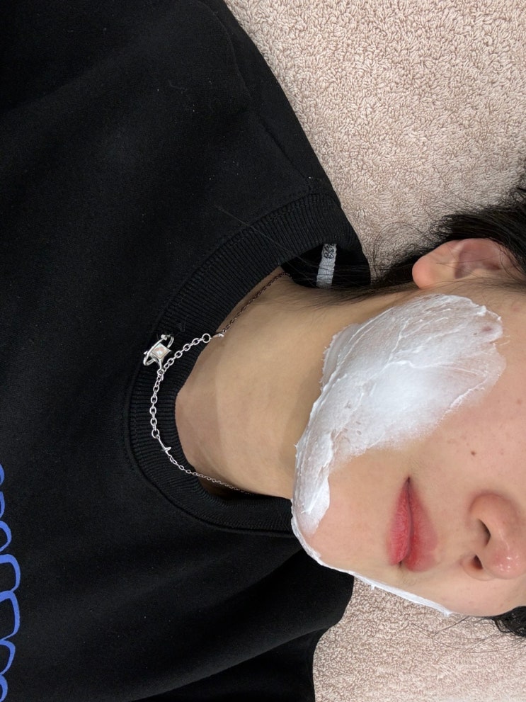  [오퍼스의원] 요새 뜨고있는 울쎄라,텐써마보다 핫안 '브이로' 200샷 받고 옴