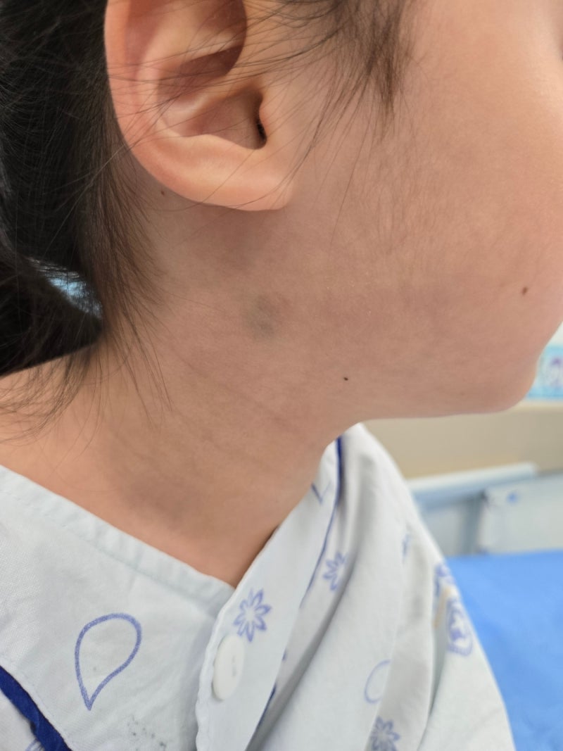 아기 피지낭종 피부과에서 치료 후 재발해 수술받았어요(영등포 한강수병원)