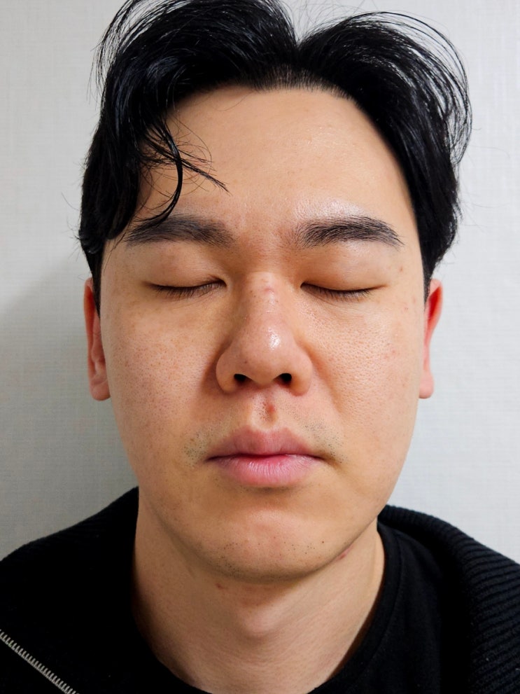  삼성역피부과 젠틀맥스프로플러스 수염 제모 6회차 후기