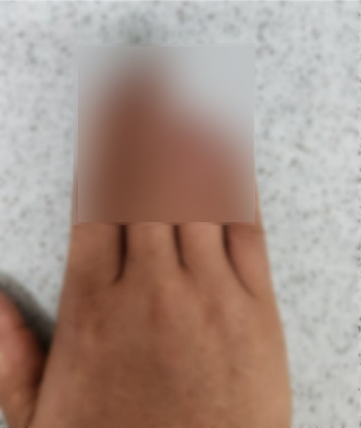 고의로 손가락 절단하고 산재보험금 타낸 브로커·외국인 검거 고의로 손가락 절단하고 산재보험금 타낸 브로커·외국인 검거