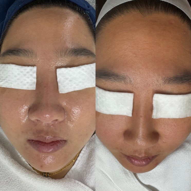  광주 문제성피부관리 수퍼젝션 양동에스테틱 엘스킨