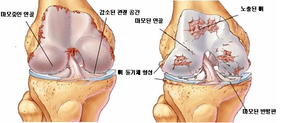  대구 무릎통증 병원, 모르면 안되는 단 1가지