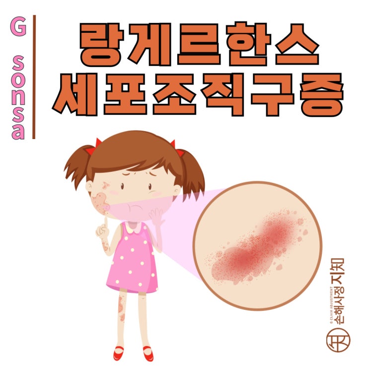  랑게르한스세포조직구증, 면역세포의 과잉 사태 - [아이의 질병, 2부]