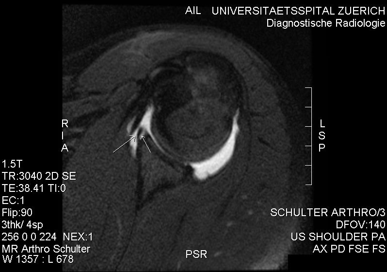 Bankart's Repair Arthroscopy: 수술 준비, 절차 및 가이드 : 네이버 블로그