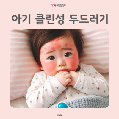 아기 콜린성 두드러기 증상 원인 알아볼게요.