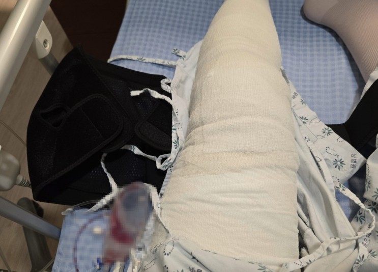 무릎 수술 추천 연골판 파열 수술 후기 반월상 연골 수평 파열 상세 분당 바른 세상 병원 비수술 치료 정형외과 추천 무릎 통증 종파열 방사파열 수원 야탑 용인 척추마취 무릎 수술 추천 연골판 파열 수술 후기 반월상 연골 수평 파열 상세 분당 바른 세상 병원 비수술 치료 정형외과 추천 무릎 통증 종파열 방사파열 수원 야탑 용인 척추마취