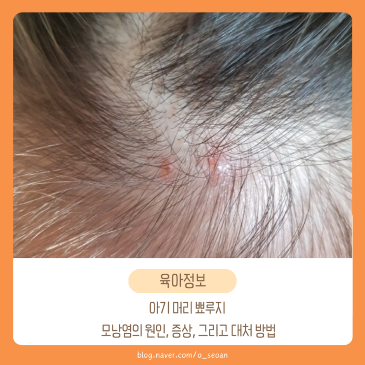  아기 머리 뾰루지 모낭염 원인, 예방법. 땀띠와 차이