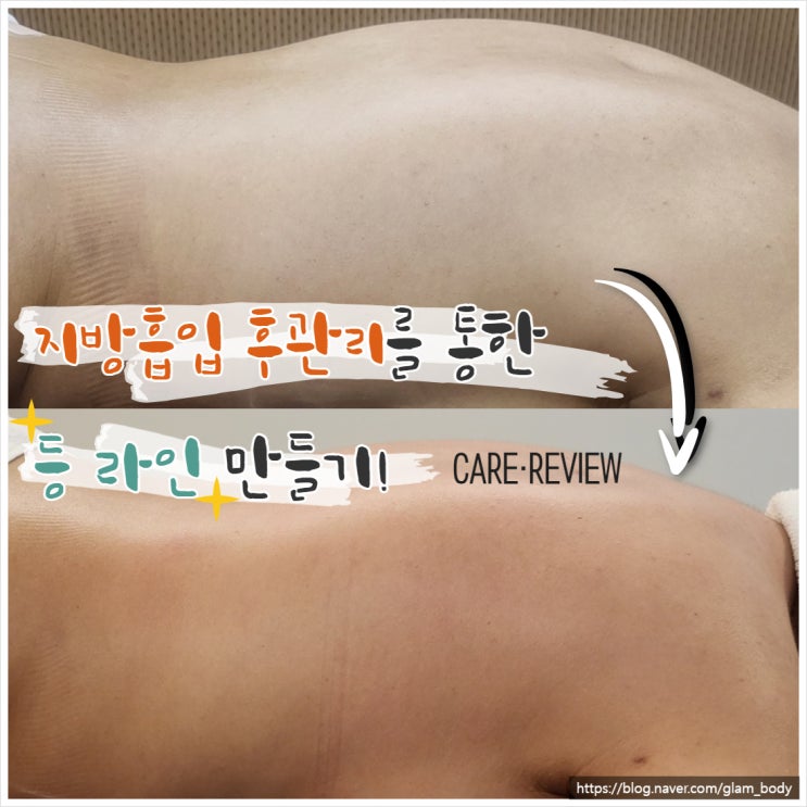  상체 지방흡입 후 등관리가 중요한 이유와 사례