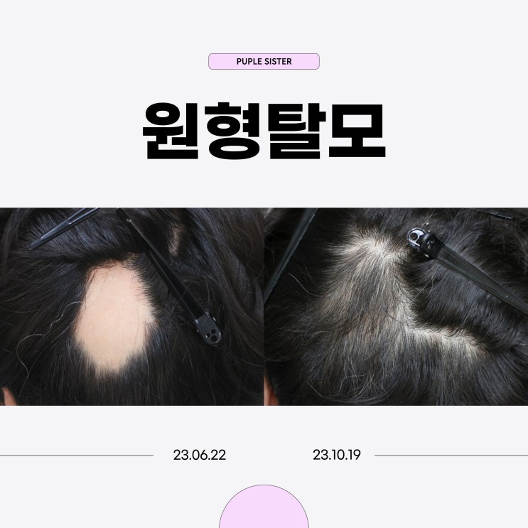  은평구피부과 원형탈모 치료, 병원은 어디로 가야할까?