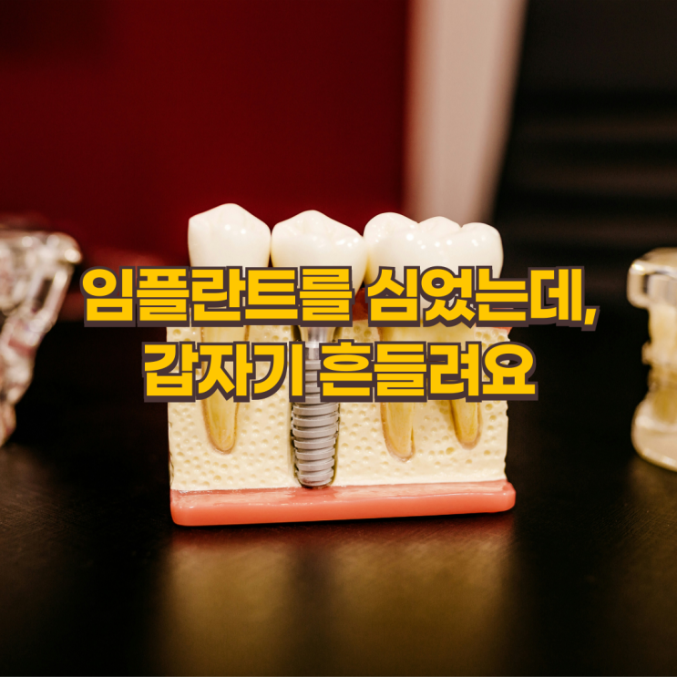  임플란트 흔들림, 얼마나 걱정해야 할까?