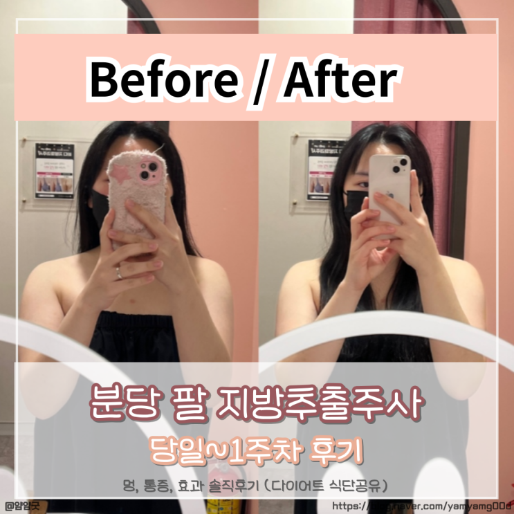  분당 팔 지방추출주사 통증, 멍, 효과 당일부터 1주차까지 후기 (운동, 식단 공유)