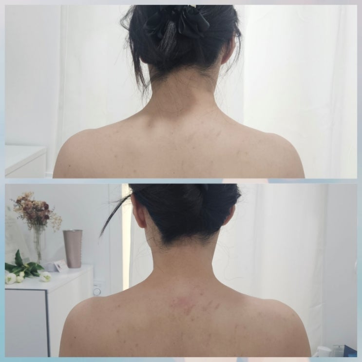  30대 40대 환절기 피부관리 방법 : 분당 서현 피부 에스테리나 물광관리 후기