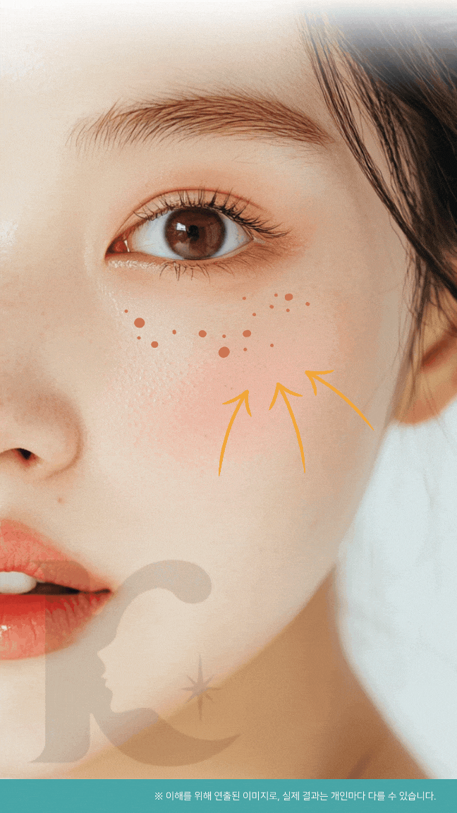  광주비립종 제거 전 사마귀와 잘 구별해야 합니다