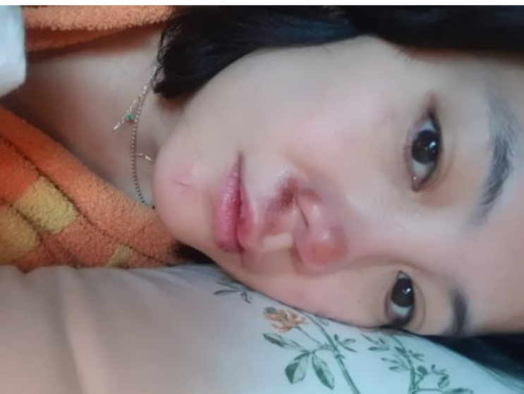 <b>고은아</b> <b>낙상사고</b>로 얼굴 <b>부상</b> <b>부상</b>정도와 당시상황 코 재수술후... 