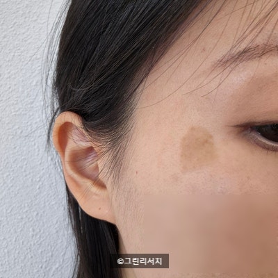  [흑자 레이저 예젤의원] 내돈내산 10년 묵은 흑자 색소침착 레이저 Part 1 (DAY 0)