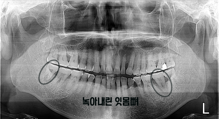 치아 정출, 잠간고정술에 대한 정보글입니다 (feat.녹아버린 잇몸)