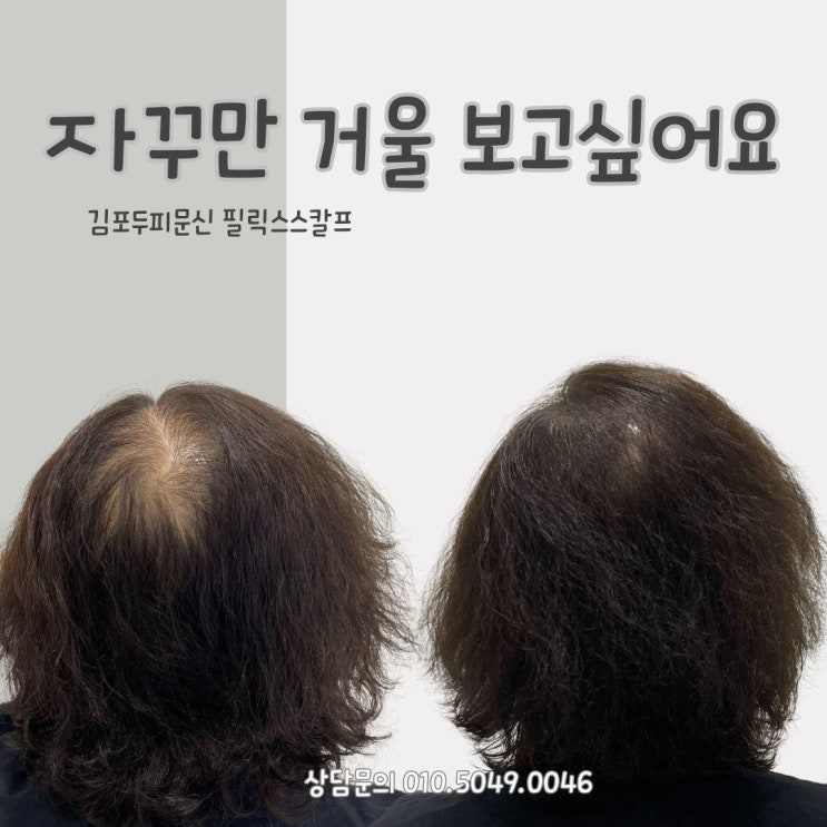  구래동두피문신후기, 60대여성정수리탈모커버