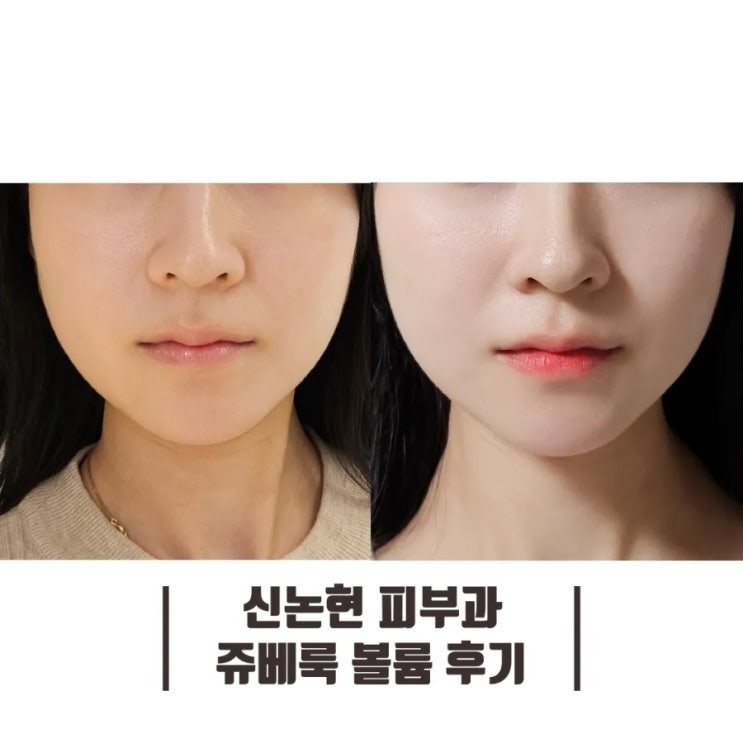  신논현 피부과 꺼진 앞볼 채우는 쥬베룩 볼륨 후기
