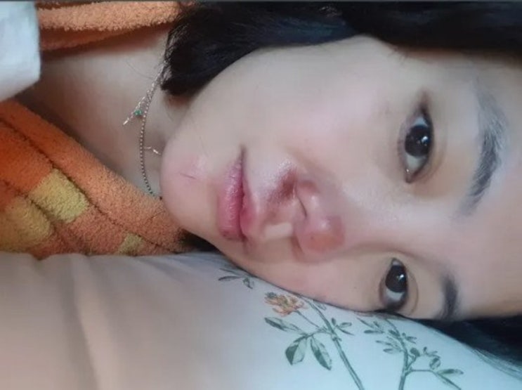 <b>고은아</b>, 빙판길 <b>낙상</b>으로 <b>안면 부상</b>…“코 수술 이후 또…”