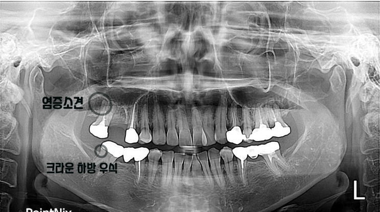달서구 추천 받는 치과 막니가 좀 흔들리면? (치과의사 작성)