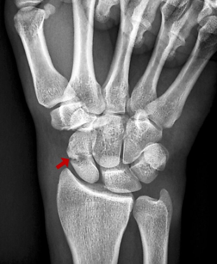 주상골(Navicular) 골절